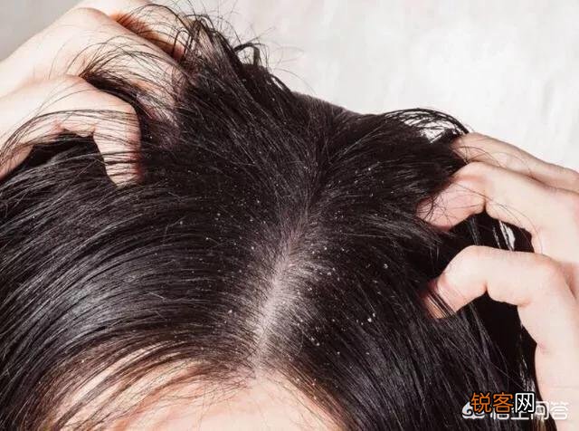 什么洗发水去油？我的头发很油,隔一天不洗就很油腻怎么办？