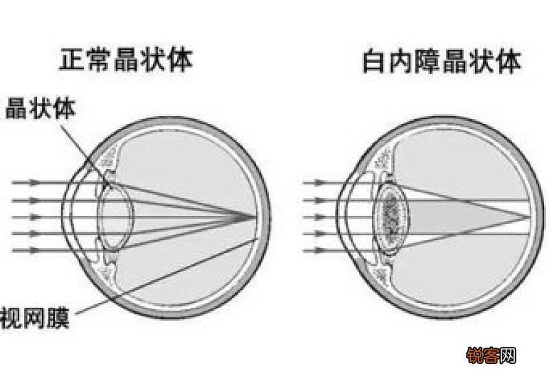 白内障是怎么引起的？白内障可以预防吗