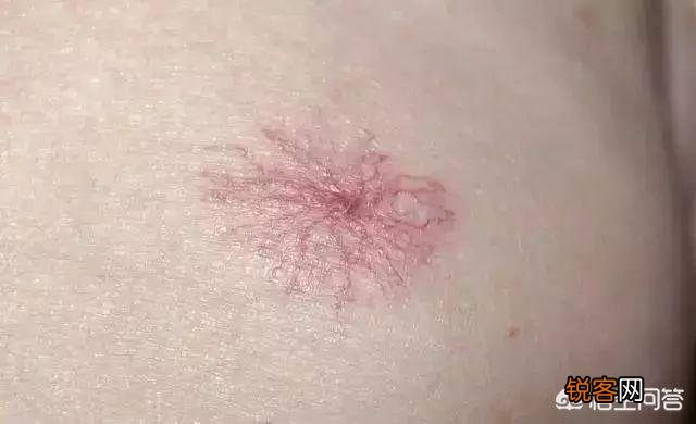 肝癌不痛不痒,出现2痣3少,要及时检查,别拖延！你知道是什么吗？