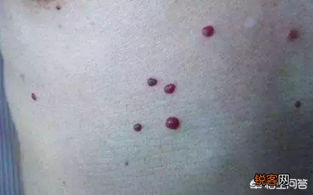 肝癌不痛不痒,出现2痣3少,要及时检查,别拖延！你知道是什么吗？