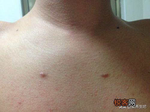 肝脏开始病变,会在身上长哪2种痣？在身体哪个部位？
