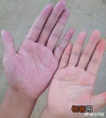 身上有小红痣,千万别大意,是大病的预警信号吗？