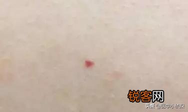 身上有小红痣,千万别大意,是大病的预警信号吗？