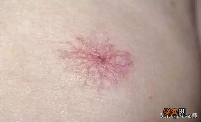 红痣究竟是不是变老、肝病的前兆？