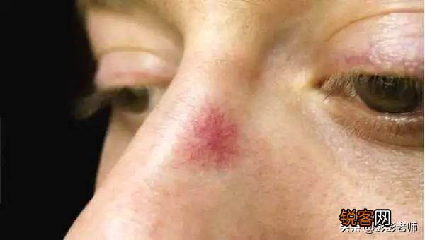 红痣究竟是不是变老、肝病的前兆？