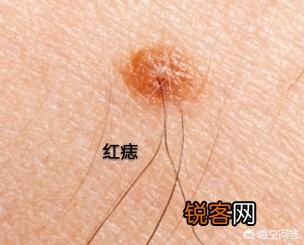 红痣究竟是不是变老、肝病的前兆？