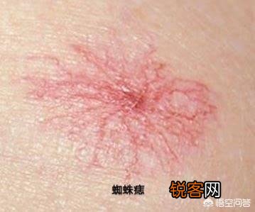 红痣究竟是不是变老、肝病的前兆？