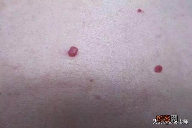 红痣究竟是不是变老、肝病的前兆？