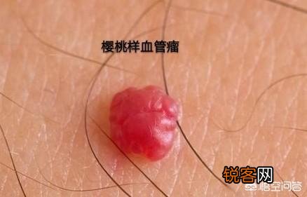 红痣究竟是不是变老、肝病的前兆？