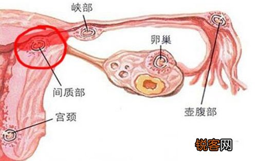 输卵管炎会惹起宫外孕吗？输卵管炎怎样医治好