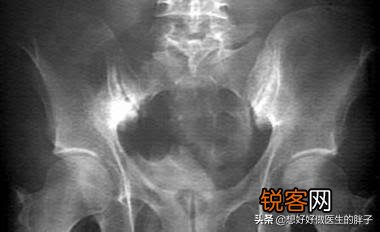 强直性脊柱炎能活多久？