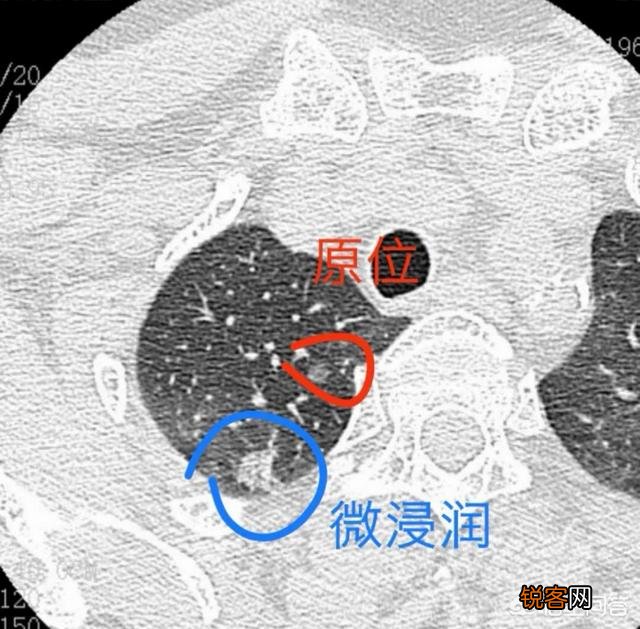 哪种癌症致死率最高？