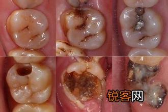 有什么速效方法缓解牙痛吗?