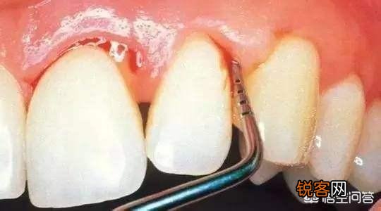 有什么速效方法缓解牙痛吗?
