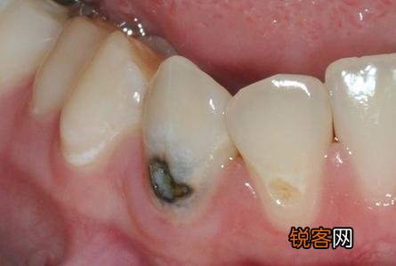 有什么速效方法缓解牙痛吗?