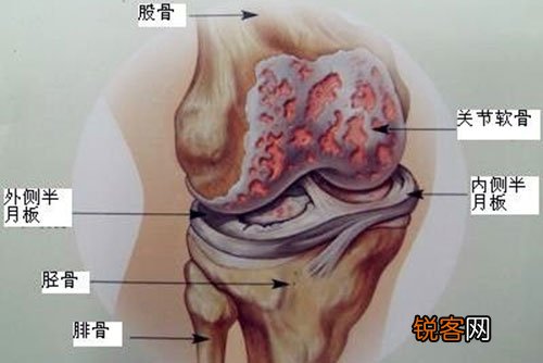 什么是退行性骨关节炎?骨关节炎患者有哪些症状