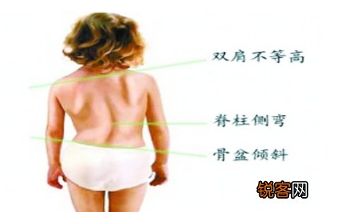 如何尽早发现孩子脊柱侧弯呢 如何尽早发现孩子脊柱侧弯？