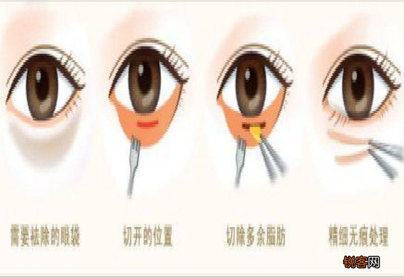 眼袋吸脂有效果吗 眼袋吸脂效果好不好
