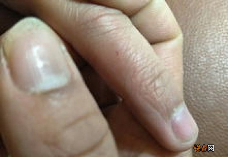 小孩让狗牙齿划破了怎么办