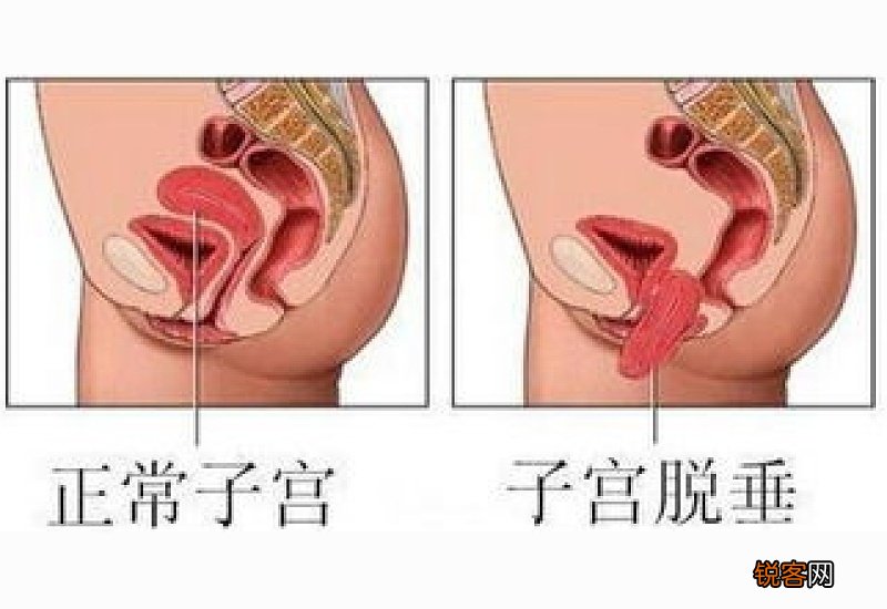 子宫脱垂的原因有哪些 子宫脱垂是怎么引起的