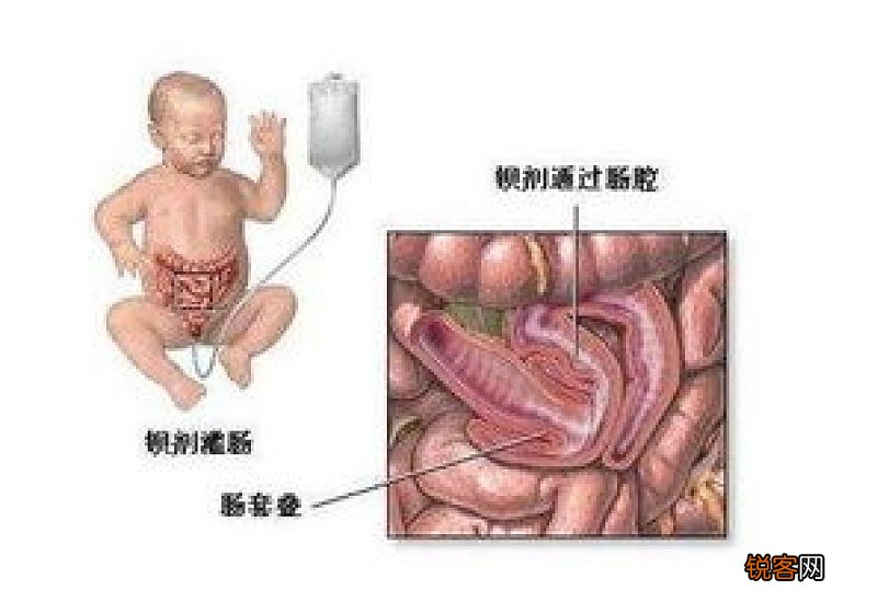 肠梗阻有什么症状？肠梗阻的症状