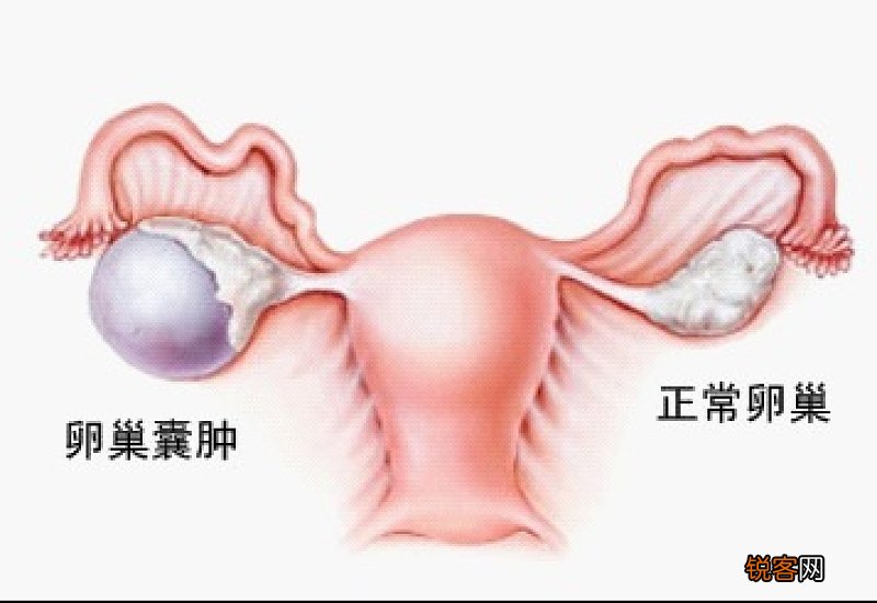 卵巢囊肿切除后遗症有哪些 卵巢囊肿手术的危害