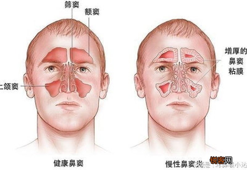 鼻窦炎和鼻炎的区别有哪些 鼻窦炎鼻炎一样吗