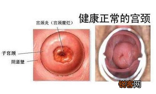 急性宫颈炎会呈现并发症 三小气法合理医治
