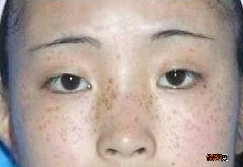 祛雀斑的好方法 祛雀斑的方法有哪些