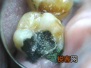 治疗蛀牙有哪些方法