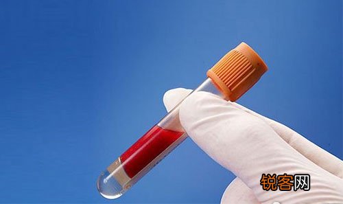 高脂血症晚期有哪些症状 六个征兆预示血脂异常