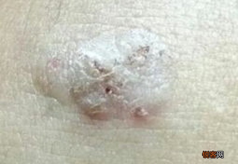 冷冻治疗扁平疣疼吗？冷冻治疗扁平疣注意事项