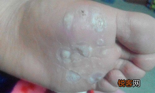 惹起跖疣的病因是什么 跖疣的无效医治办法