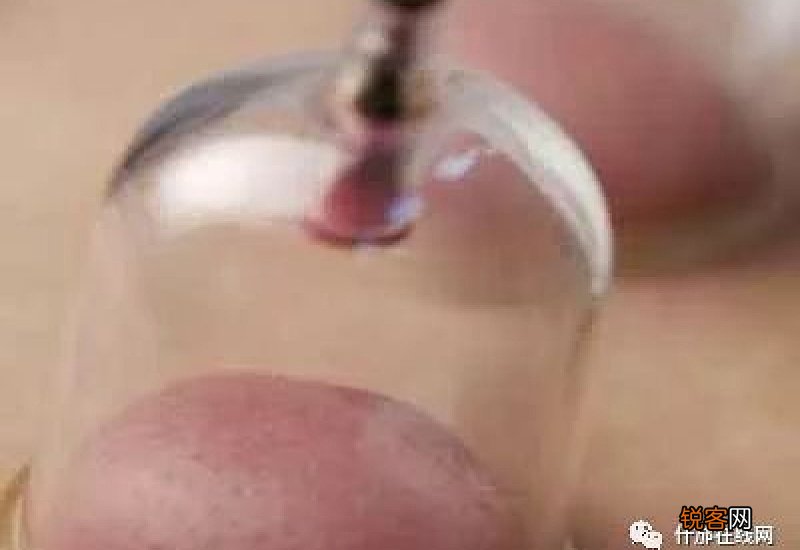 为什么拔罐肩膀最黑 拔完罐犯困怎么回事