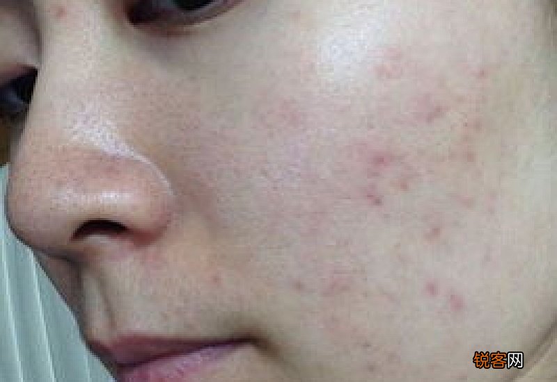 为什么脸上突然毛孔粗大
