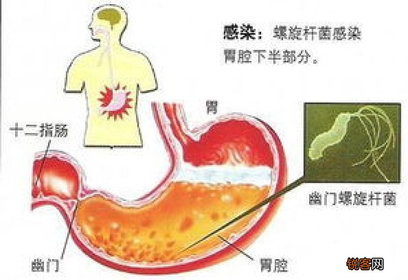 碗筷怎么消毒才能杀死幽门螺杆菌