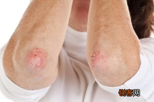 女性保健注意 女性私处易患这4种皮肤病