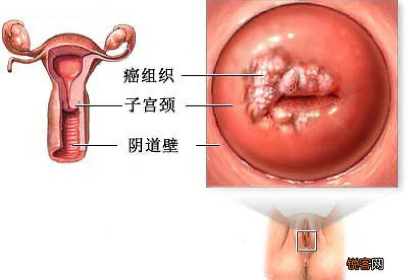 宫颈癌晚期能活多久 晚期宫颈癌能活多久