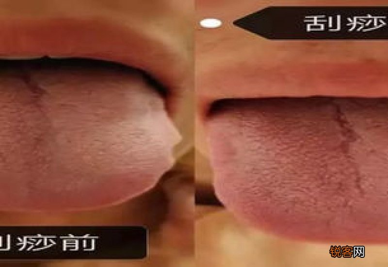 刮痧出痧好还是不出痧好 为什么刮痧会出现紫色的颗粒状