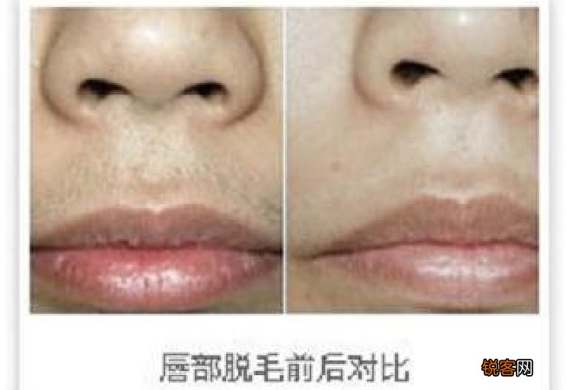 脱唇毛一个月了黑印还没消