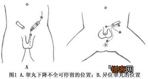 什么是隐睾？怎样反省睾丸地位？