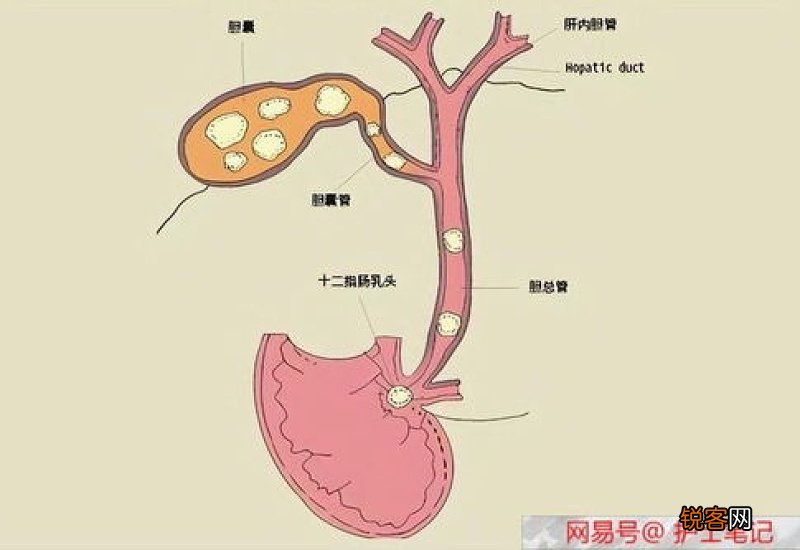 以前都是保胆取石 现在查出胆结石为什么要切胆囊 原因令人深思