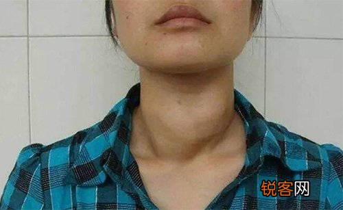 甲状腺癌有什么表示？患者术后有哪些留意事项？