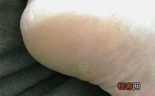 跖疣晚期有哪些罕见症状 跖疣的初期症状