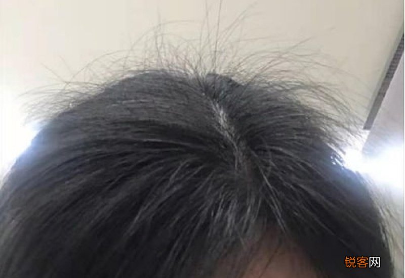 突然严重脱发是什么原因引起的