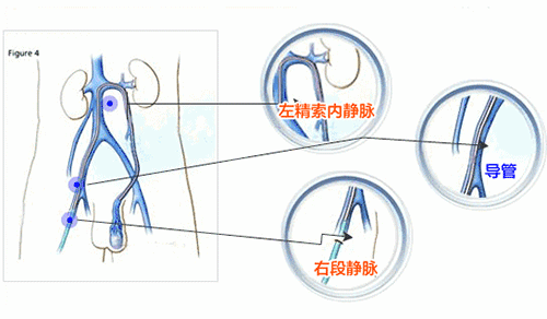 精索静脉曲张的诱因有哪些 精索静脉曲张如何医治