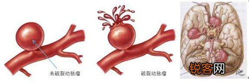 警觉头疼欲裂伴有放射状呕吐！夏季小心脑动脉瘤作祟