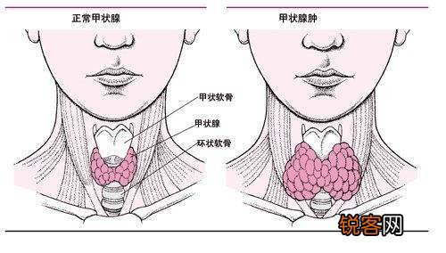甲状腺癌的早期有哪些症状 平常如何自查甲状腺癌