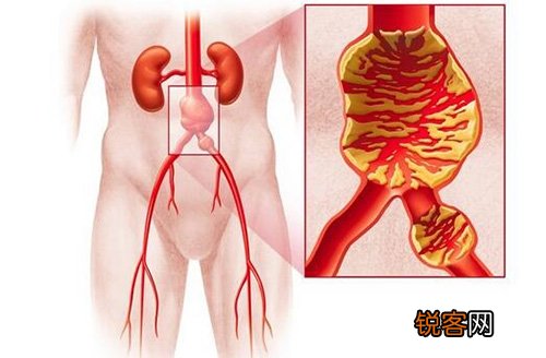 腹自动脉瘤怎样护理？术前术后护理惯例