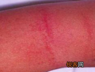 猩红热有什么特点 猩红热有哪些特别的表示